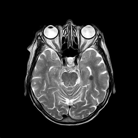 MRI Scans with Contrast and How They Differ From .